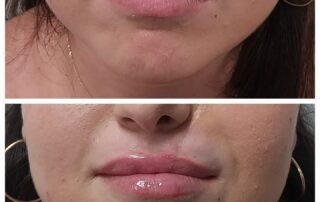 Tratamiento de ácido hialurónico para tratamiento de reparación facial